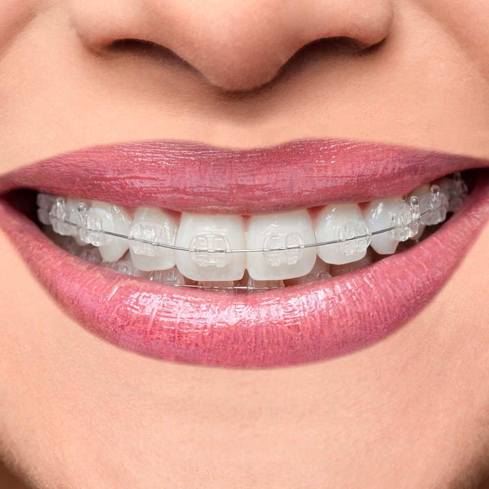 Iceram – P (Sapphire Polycrystalline)